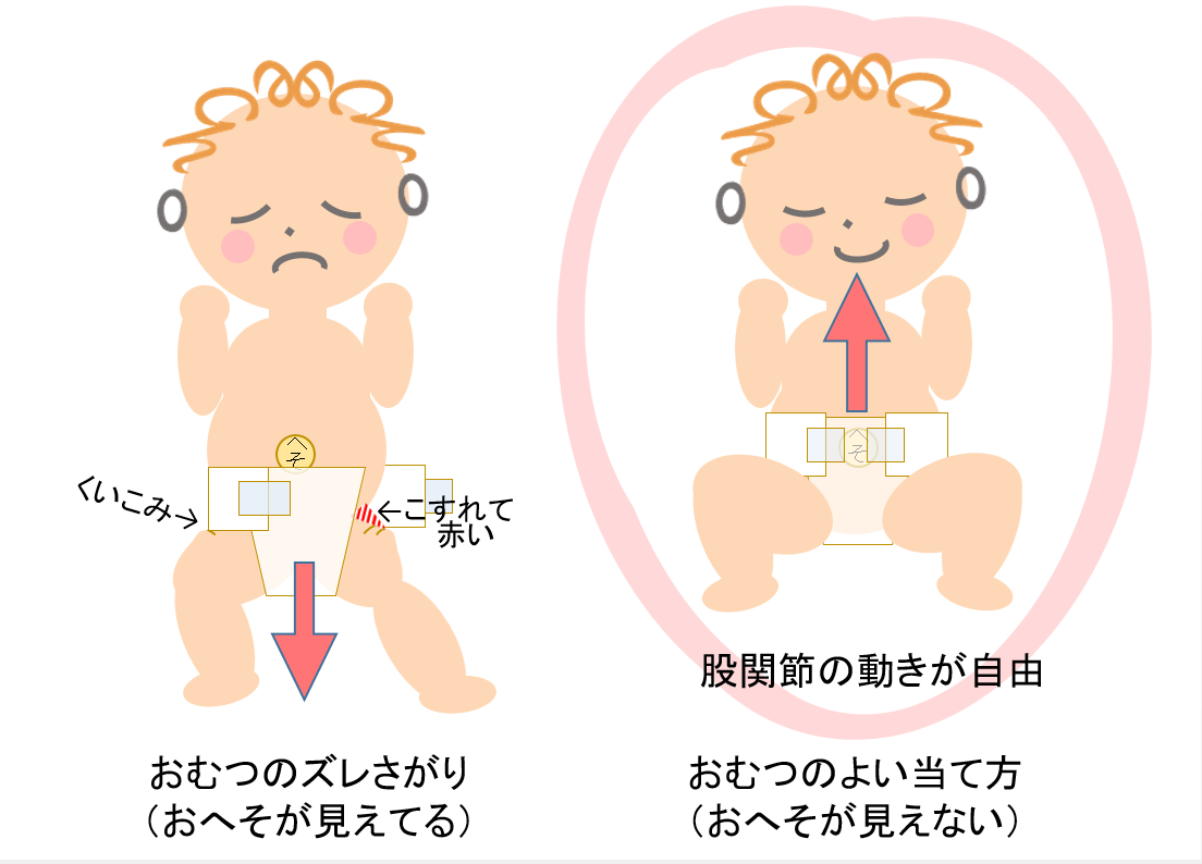 赤ちゃん 股関節 脱臼 しわ の 深 さ